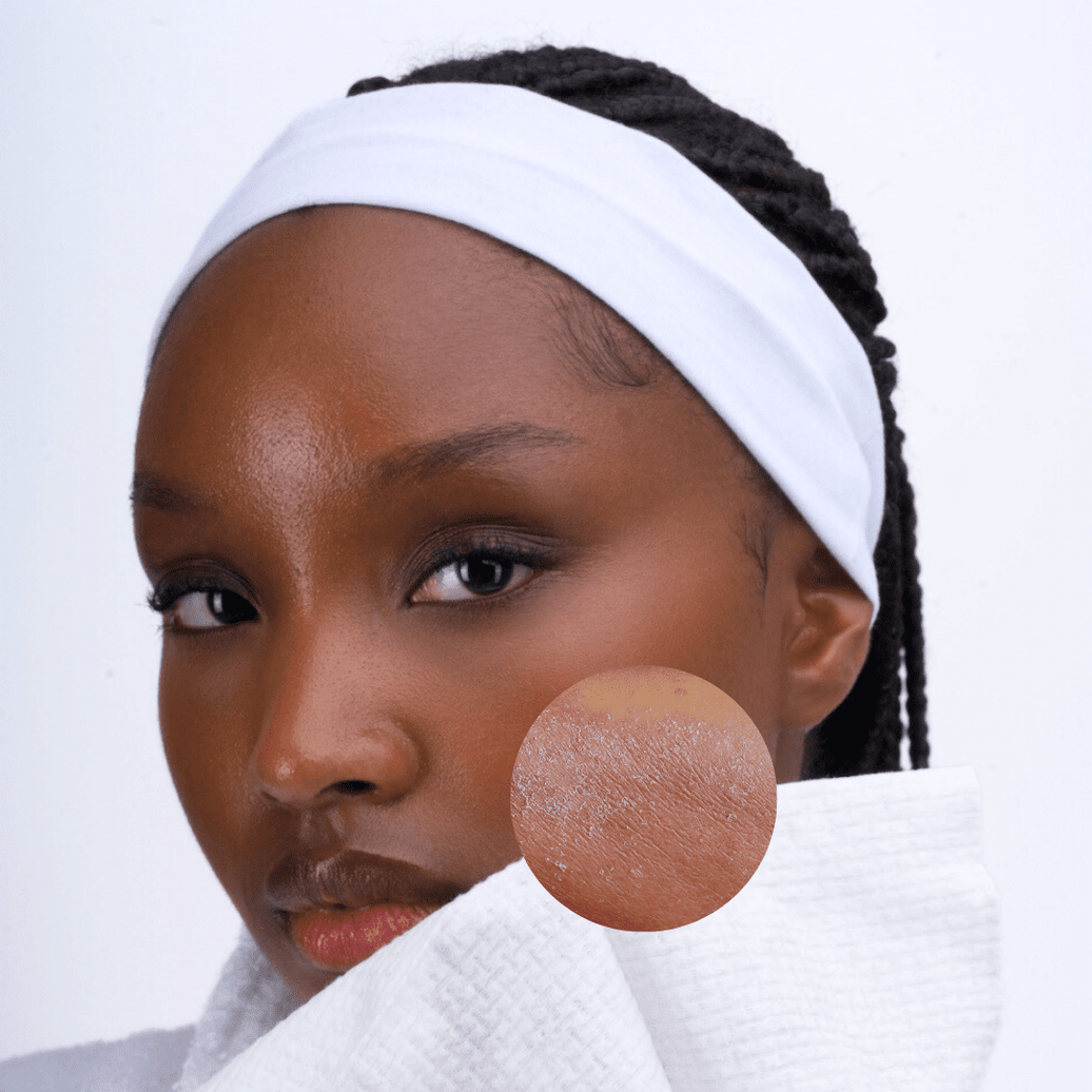 Why Winter Is the Season to Protect Your Skin Barrier - ISOCLEAN