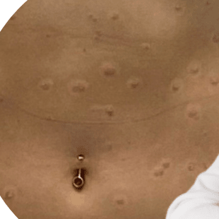 Shannon’s Psoriasis