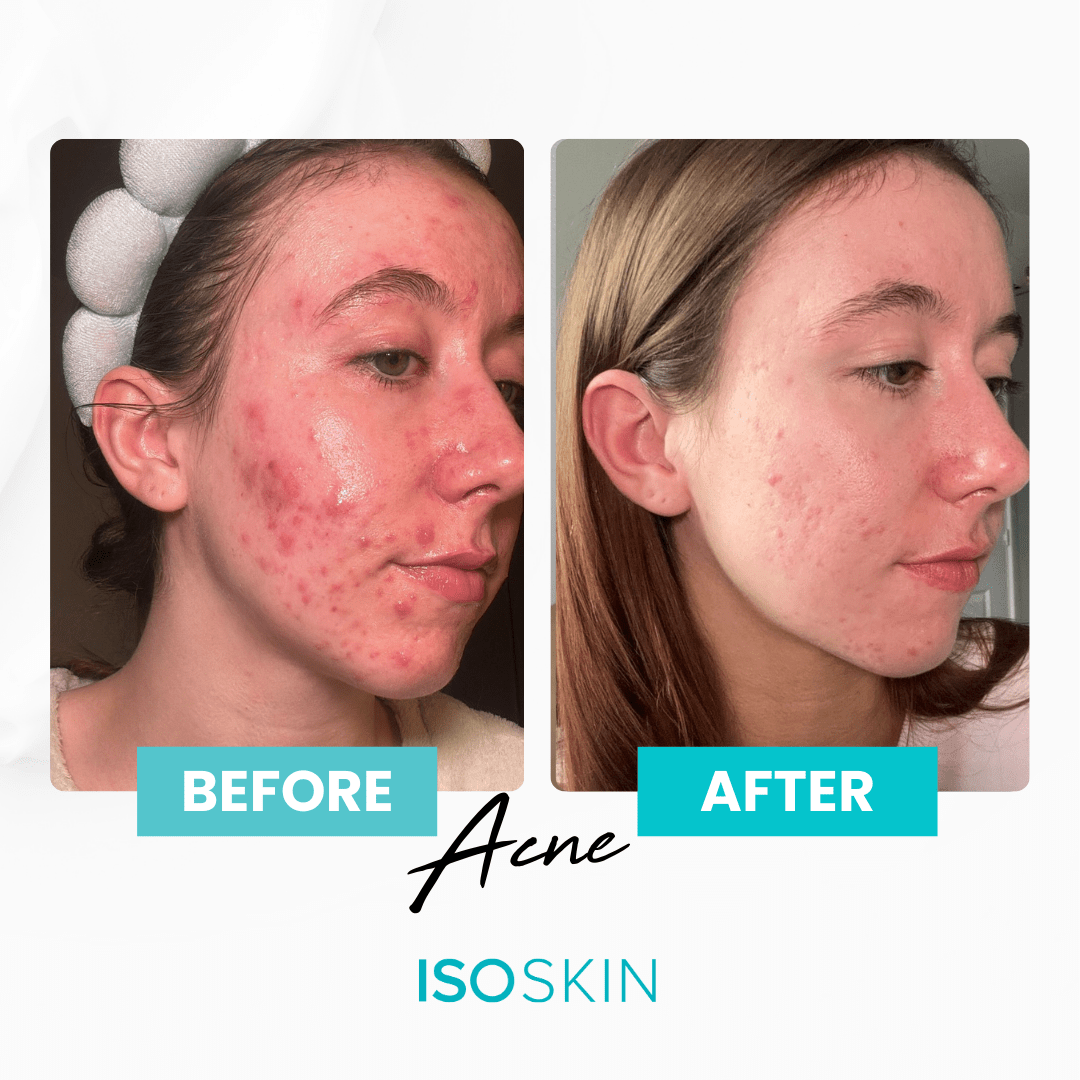 ISOSKIN BUNDLE - Isoclean