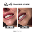 ISOHEALTH Teeth Whitening Strips (28 strips) Available In Clear Or Carbon - ISOCLEAN