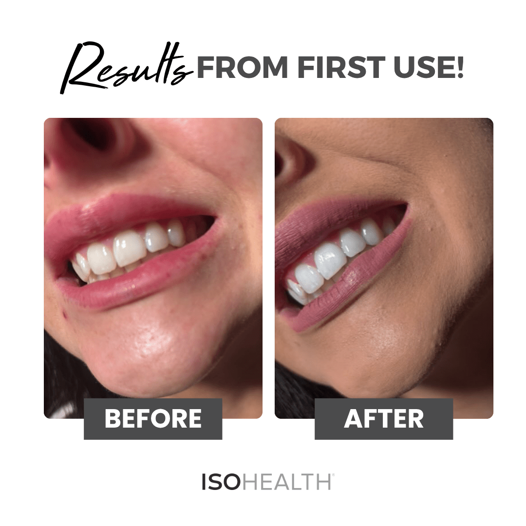 ISOHEALTH Teeth Whitening Strips (28 strips) Available In Clear Or Carbon - ISOCLEAN